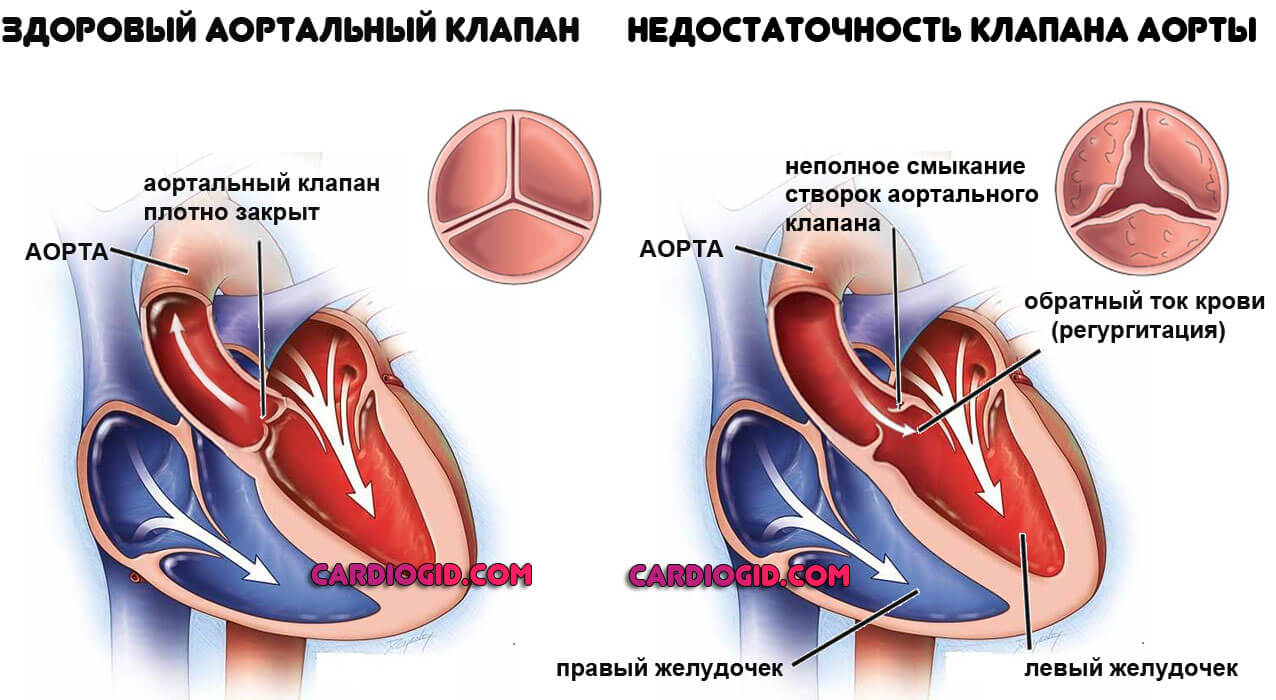 недостаточность аортального клапана