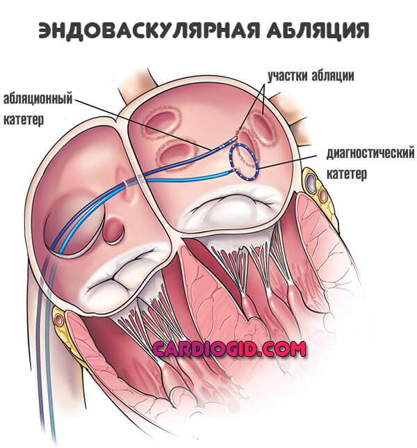 эндоваскулярная абляция