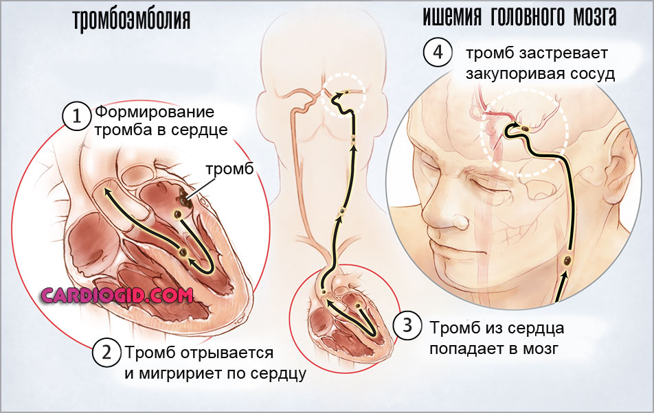 тромбоэмболия головного мозга