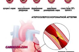 атеросклероз-коронарной-артерии