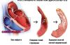 постинфарктный-кардиосклероз