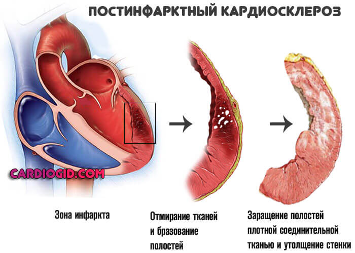 постинфарктный-кардиосклероз