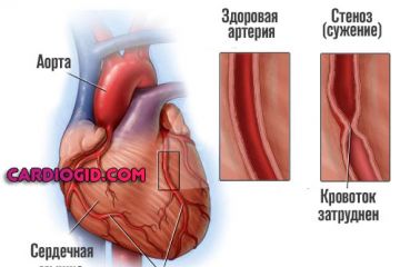 стеноз-коронарной-артерии
