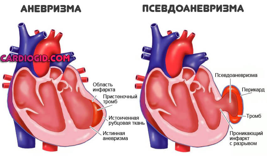 аневризма-сердца
