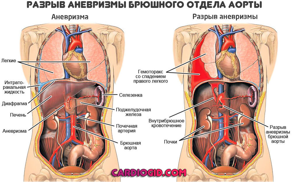 разрыв-аневризмы-брюшного-отдела-аорты
