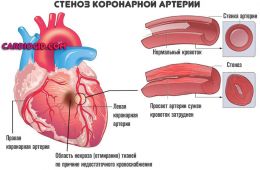 стеноз-коронарной-артерии