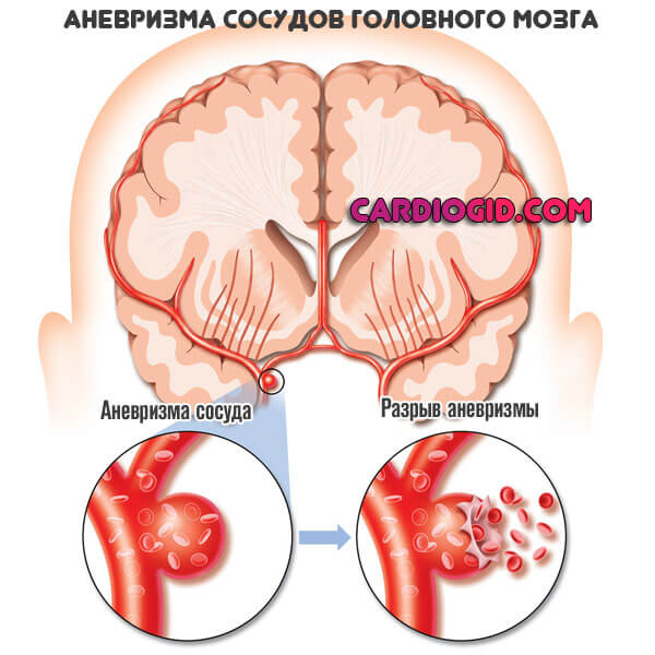 аневризма-сосудов-мозга