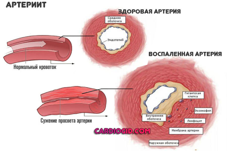 артериит