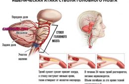 ишемическая-атака-ствола