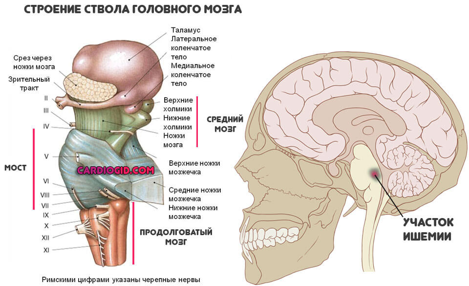 ишемия-ствола-головного-мозга
