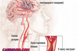 цереброваскулярная-недостаточность