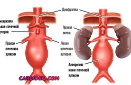 аневризма-выше-и-ниже-почечной-артерии