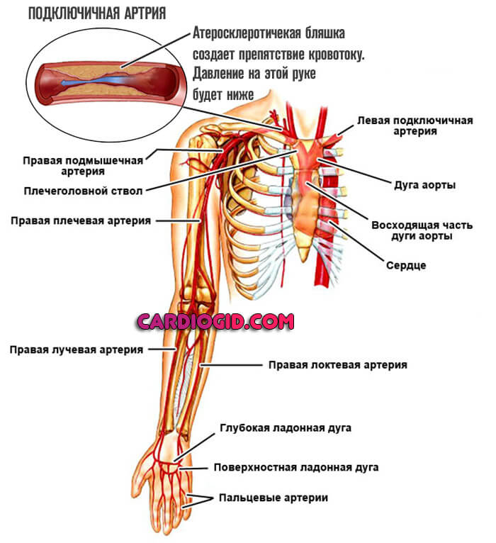 атеросклероз-подключичной-артерии