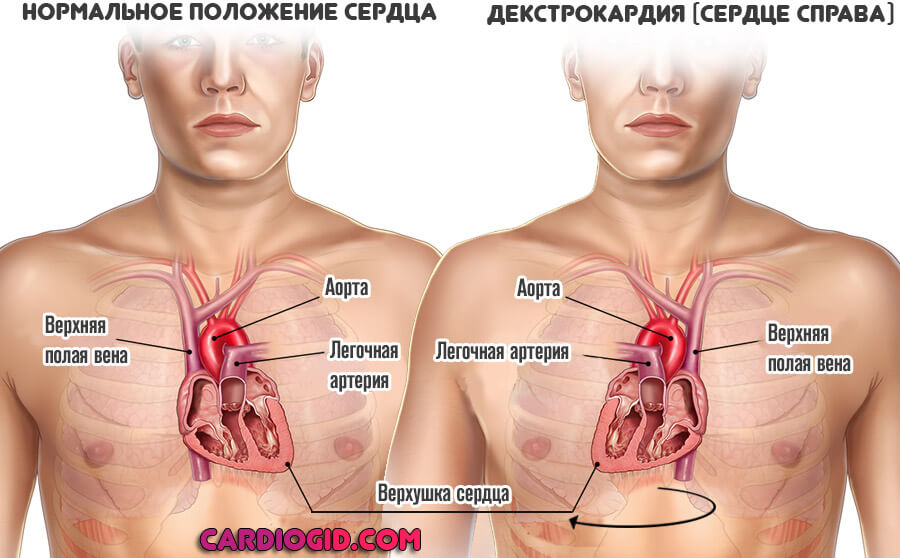 декстрокардия-сердце-справа