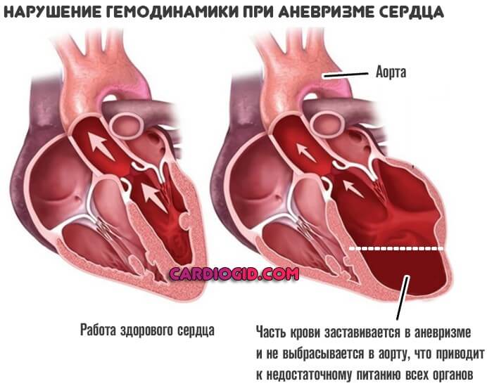 гемодинамика при аневризме сердца