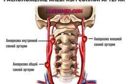 локализация-аневризм-сонных-артерий