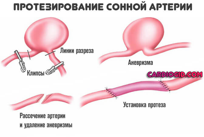 протезирование-сонной-артерии