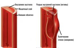 расслаивающая-аневризма-аорты-1