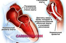 расслоение-аорты