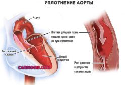 уплотнение-аорты