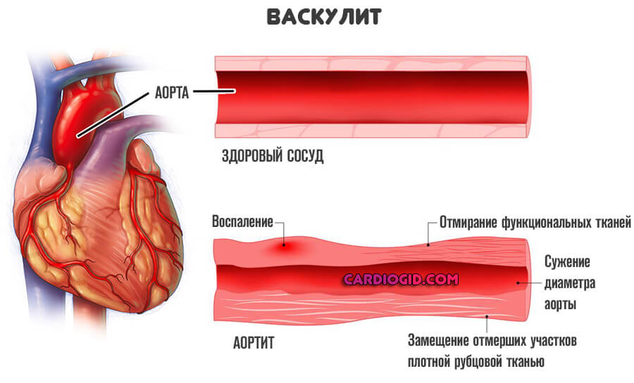 Vasculitis pulmonares