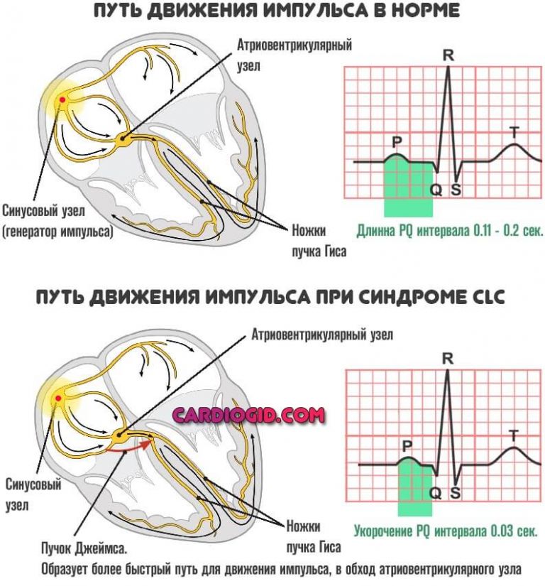 Увеличение интервала pq. CLC синдром ЭКГ. ЭКГ при синдроме CLC. Синдром СLС частота. Дополнительные пути проведения и ЭКГ синдромы.