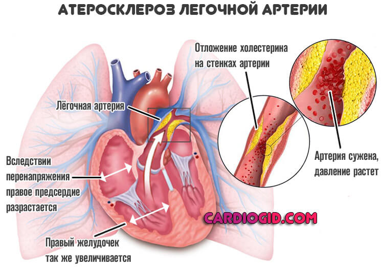 атеросклероз-легочной-артерии-с-гипертрофией-ПП