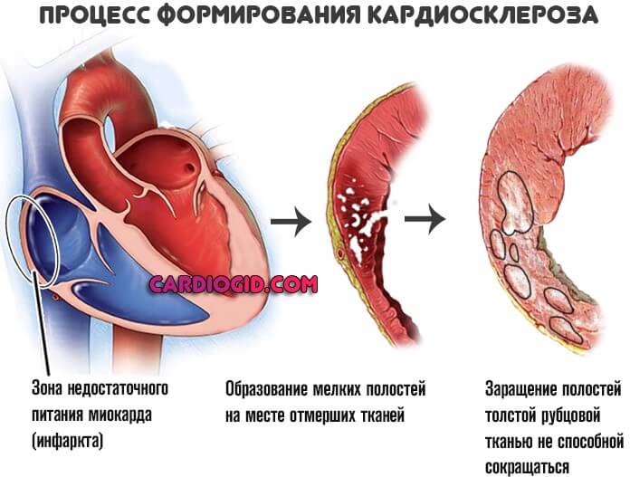 кардиосклероз правого предсердия