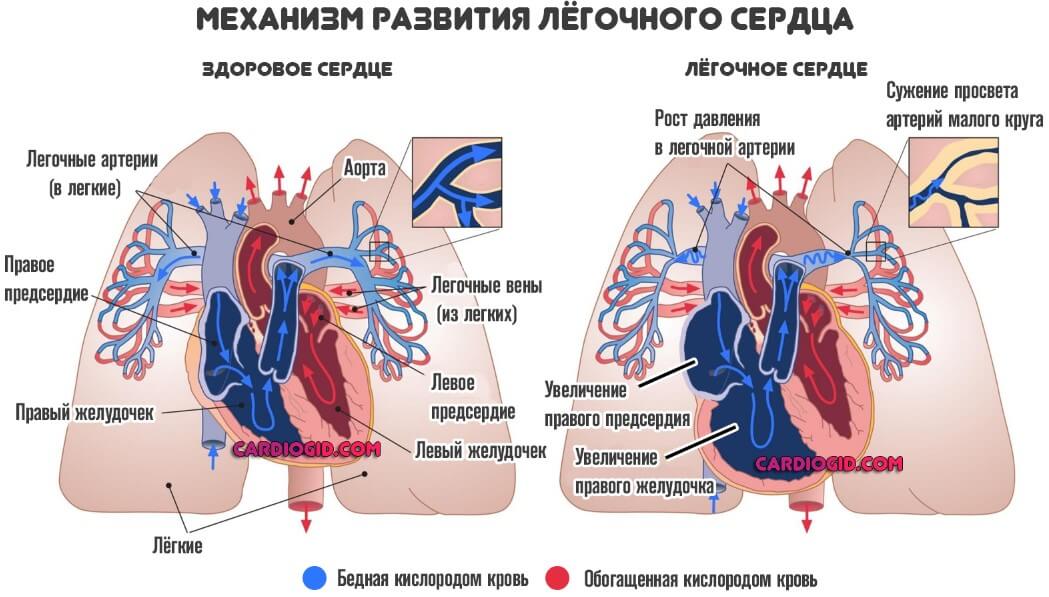 легочное сердце при бронхиальной астме
