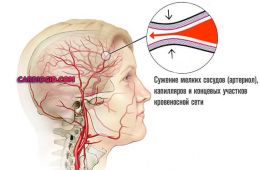 спазм сосудов головного мозга
