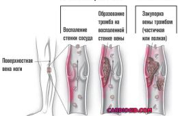 тромбофлебит-и-тромбоз