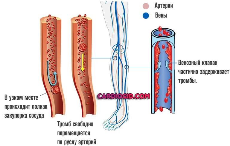 венозный и артериальный тромбоз