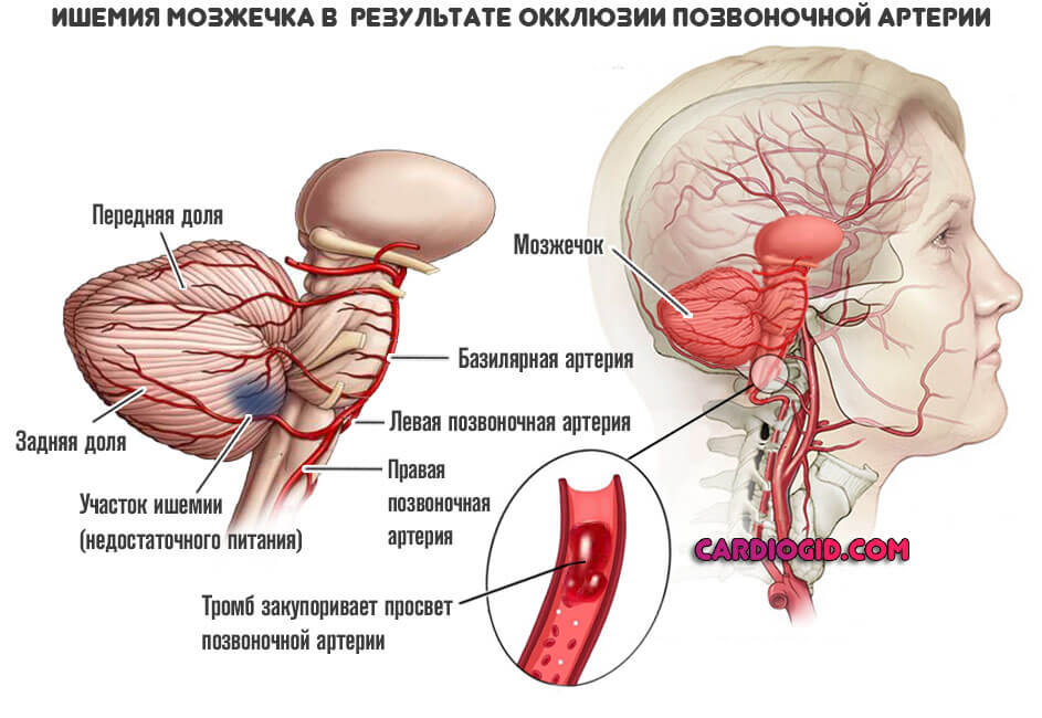 ишемия-мозжечка-в-результате-окклюзии