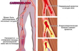 стадии-облитирующего-атеросклероза