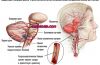 атеросклероз-церебральных-сосудов