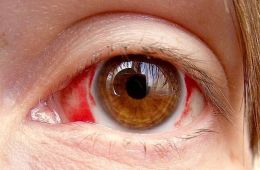 кровоизлияние в глаз