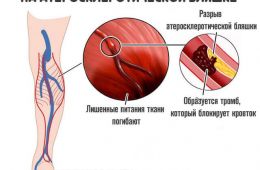 образование-тромба-на-атеросклеротической-бляшке