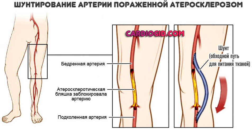 шунтирование артерий ног