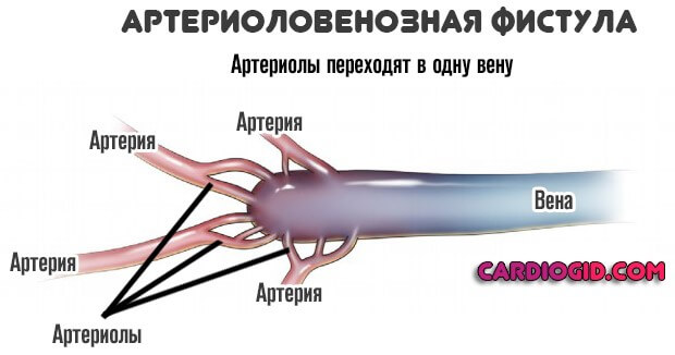 Артериоловенозная фистула