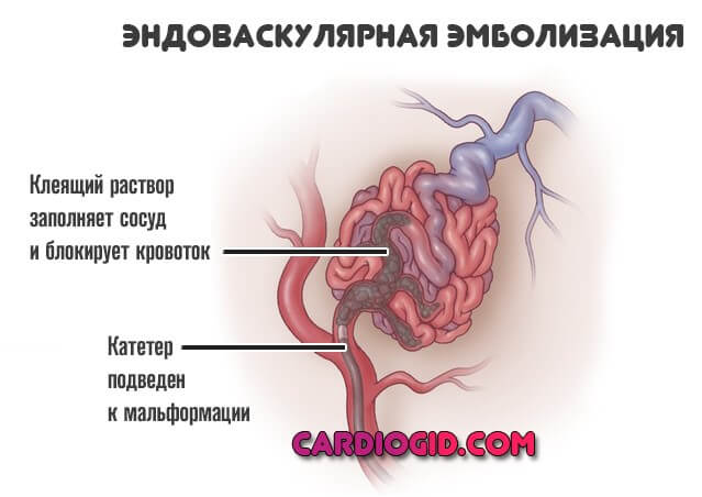 Эндоваскулярная операция аневризмы головного. Эмболизация АВМ сосудов головного мозга. Артериовенозная мальформация эндоваскулярная эмболизация. Мальформации сосудов головного мозга. Артериально венозная мальформация сосудов.