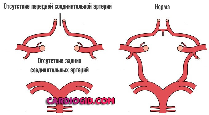остутствие всех соединительных артерий