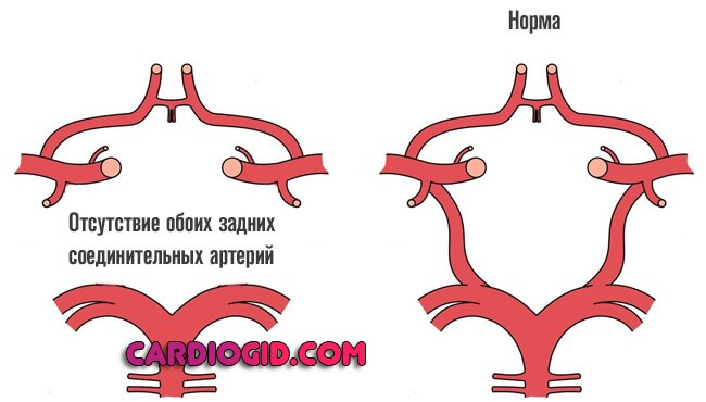 отсутствие задних соединительных артерий