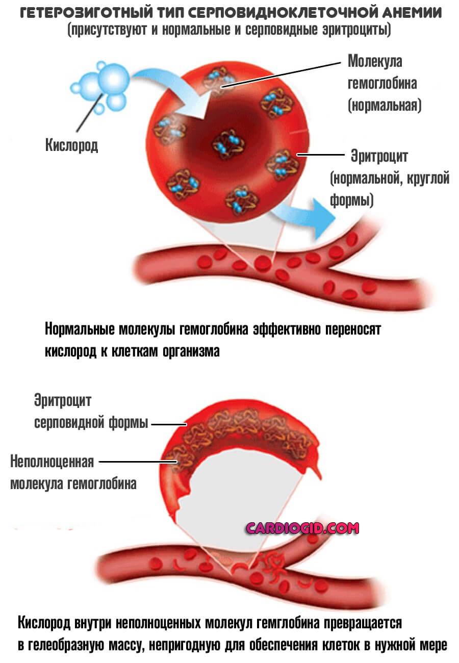 гетерозиготная-СКА