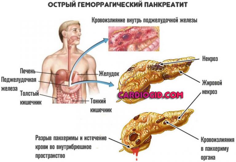 Хронический панкреатит рисунок