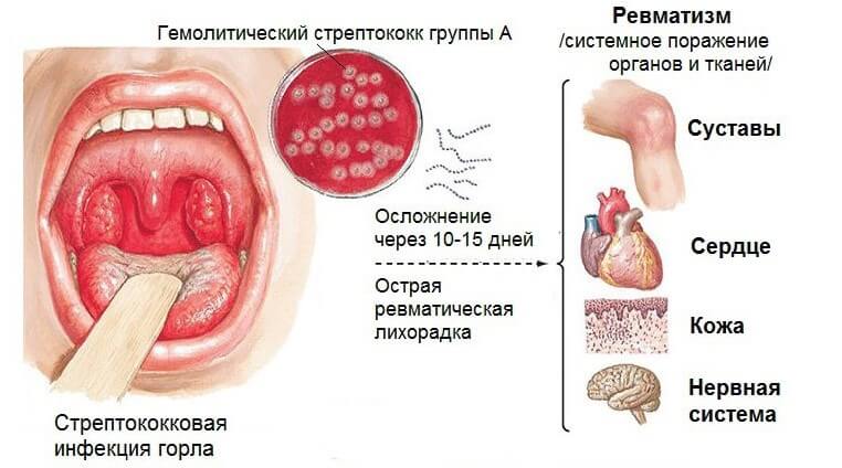 осложнения стрептококковой инфекции