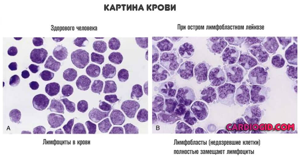картина крови при остром лейкозе