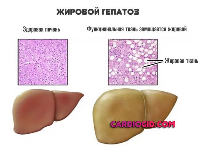 жировой гепатоз